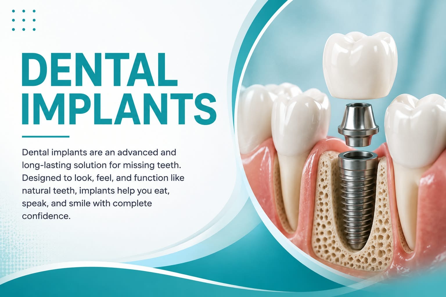 Dental Implants