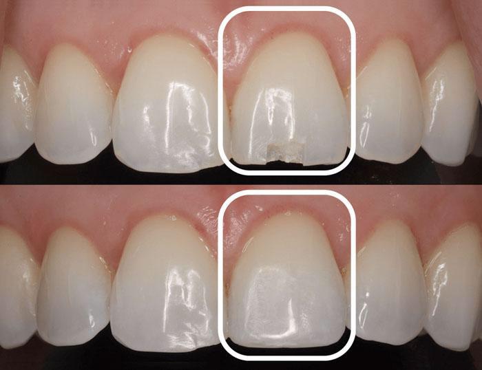 Etching the tooth