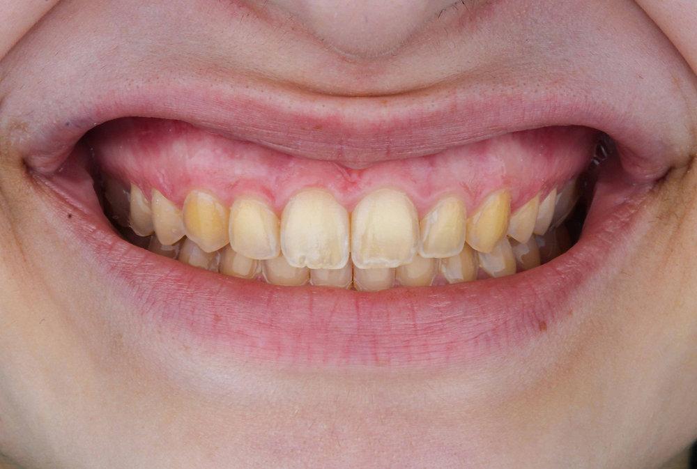 Cleaning the tooth