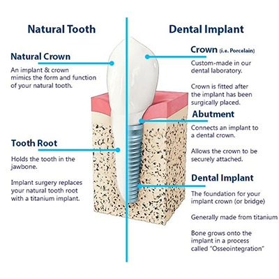 Dental Implant