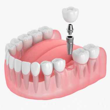 Multiple tooth implants