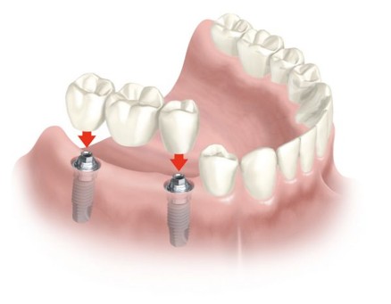 Full mouth implant