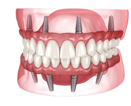 Full mouth implant