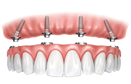 Immediate implant