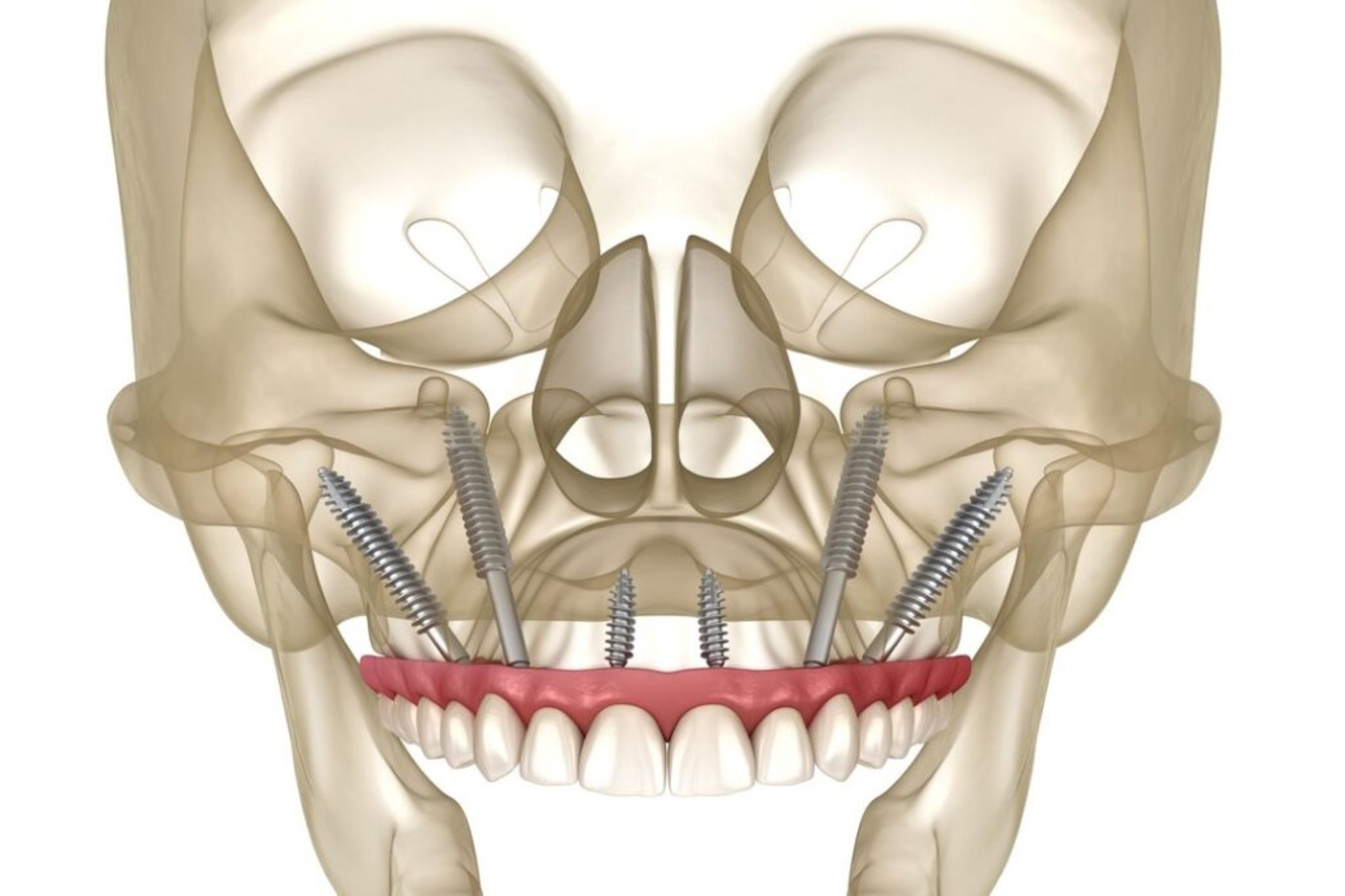 Zygomatic implant
