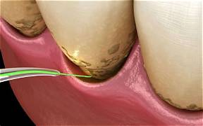 Laser Dentistry