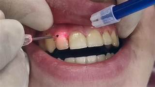 Laser Dentistry