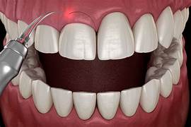 Laser Dentistry