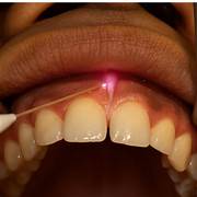 Laser Dentistry