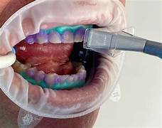 Laser Dentistry