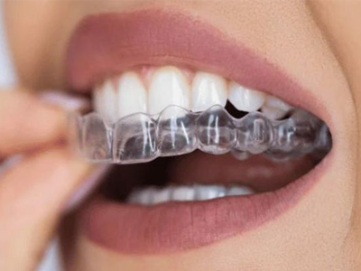 Clear aligners and Invisalign