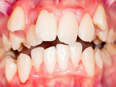 Crowding teeth