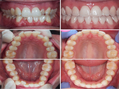 Functional jaw orthopedics and interceptive orthodontics