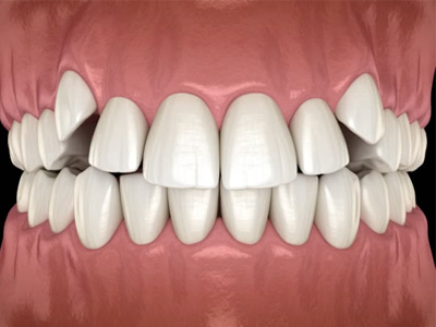 Impacted teeth
