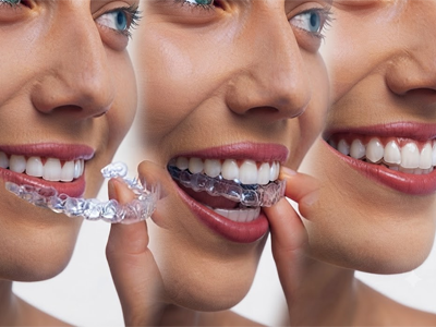 Invisalign clear aligners