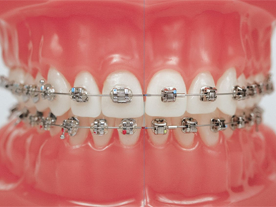 Metal and clear braces