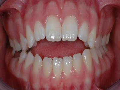 Open bite