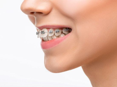 Overbite