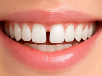 Gaps between teeth