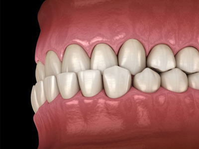 Underbite
