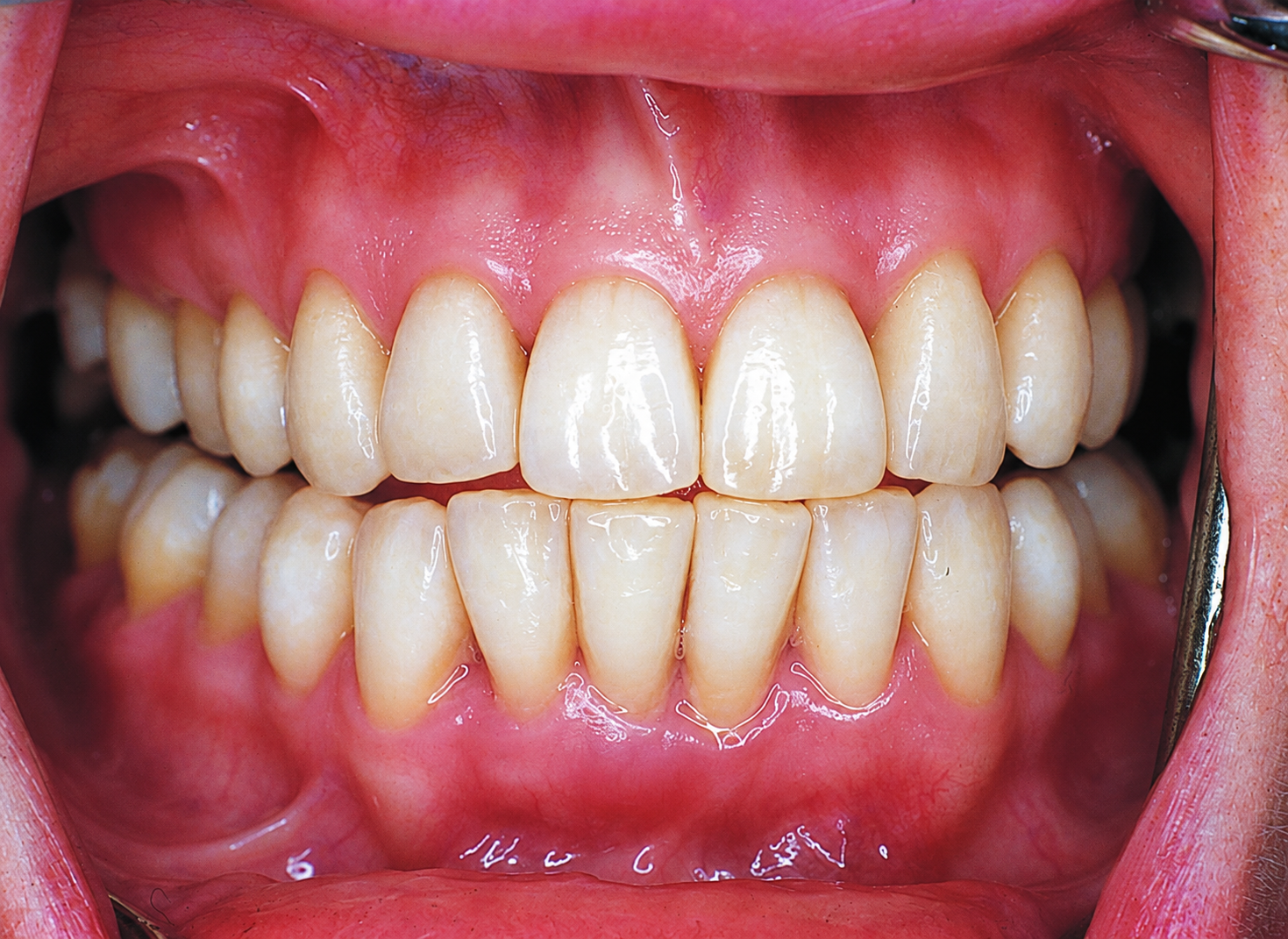  Fluorosis stains after non-invasive treatment