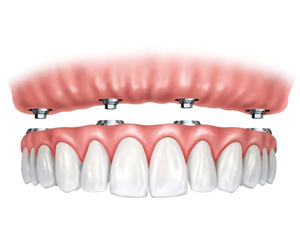 All on Four Dental Implants