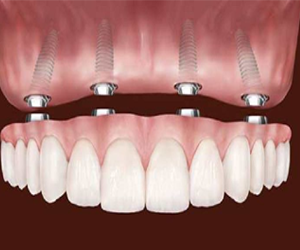 All on Four Treatment