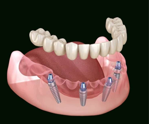 All on Four Dental Restoration