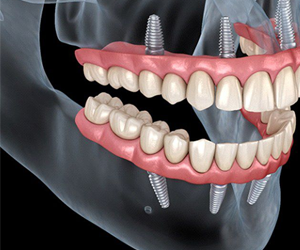 All on Four Prosthesis
