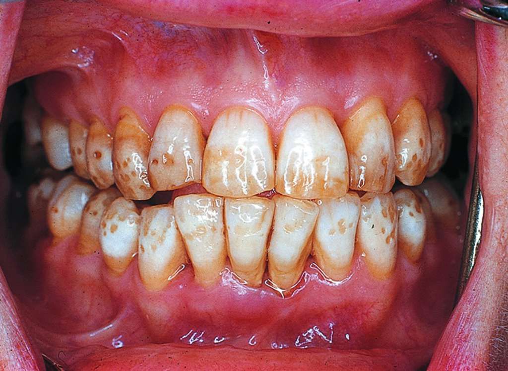 Early fluorosis brown stains before treatment