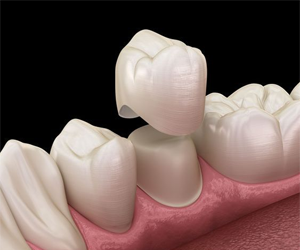 Dental Crown Treatment