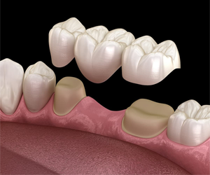 Crowns and Fixed Partial Dentures