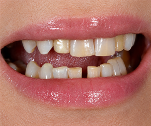 Full Mouth Rehabilitation