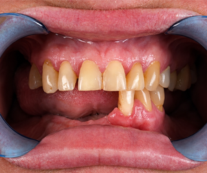 Full Mouth Dental Rehabilitation