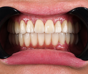 Full Mouth Restoration