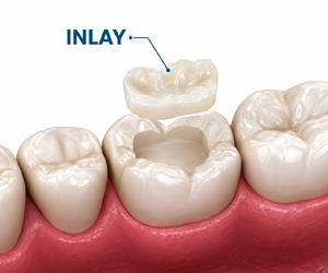 Implant Supported Prosthesis