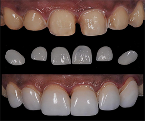 Dental Laminates and Veneers