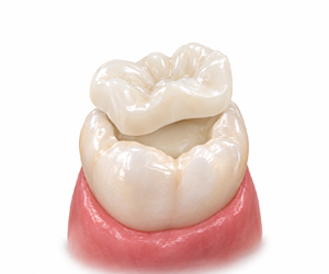 Implant Supported Dental Prosthesis