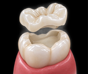 Implant Prosthesis Treatment