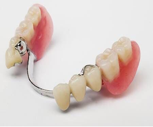 Partial Denture Treatment