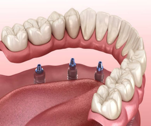 Implant Supported Overdenture