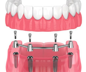 Implant Overdenture Treatment