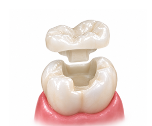Dental Implant Restoration