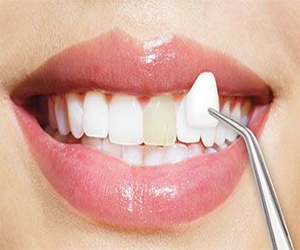 Dental Veneers Treatment