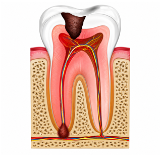 All on Four Dental Implants