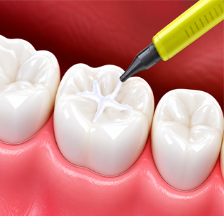 All on Four Dental Implants